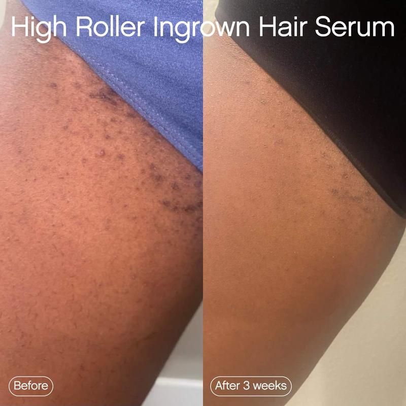 High Roller Ingrown Hair Tonic with AHA and BHA